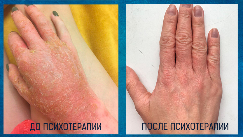 результат работы психотерапевта